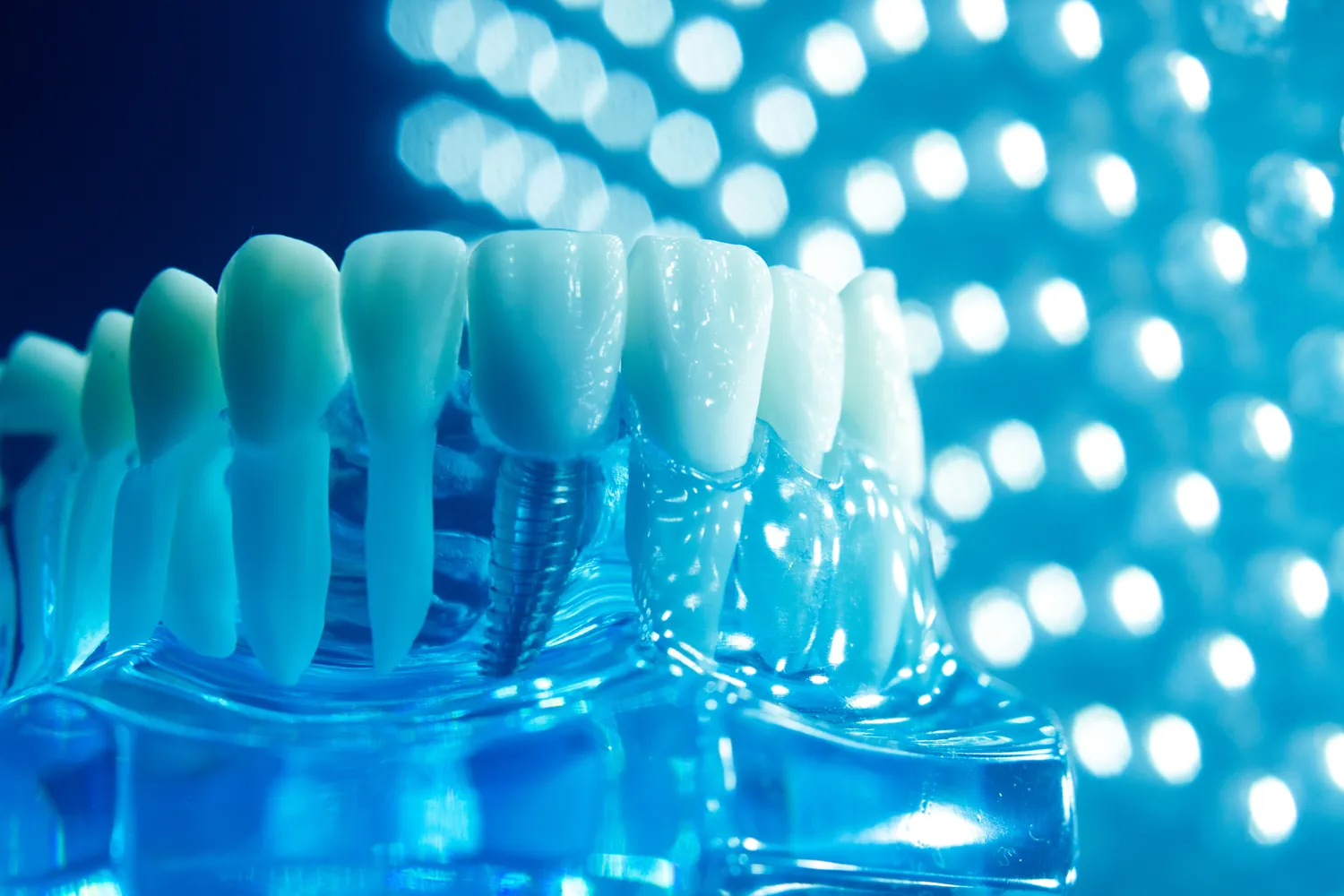 Implanty zębów - czy mogą nam zastąpić prawdziwe zęby?